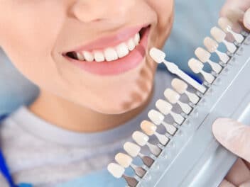 choisir meilleure facette dentaire